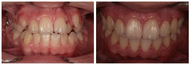 Inghesuiri dentare cu ectopie canin