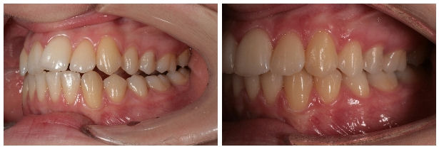 Trataament ortodontic