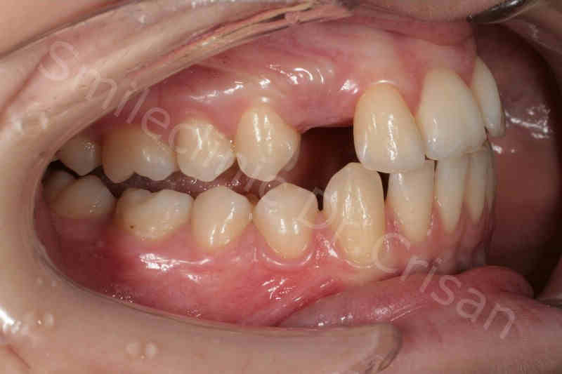 Caninul inclus