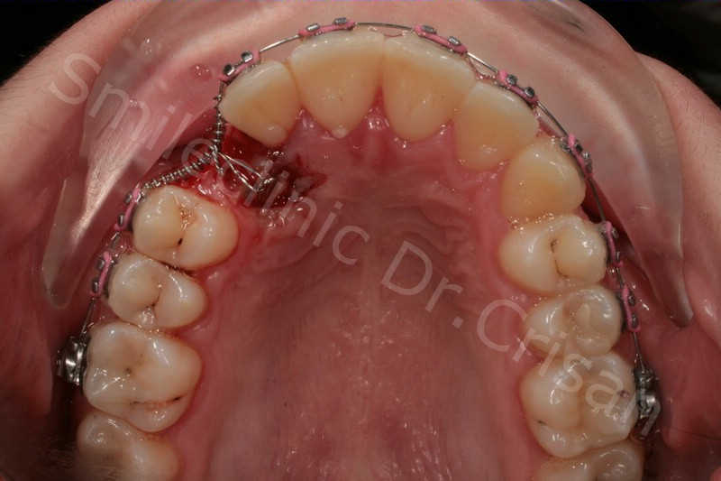 Aparat dentar canin inclus