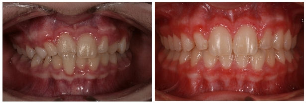 Ectopie incisiv lateral inferior