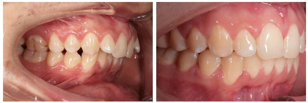Sindrom tratat cu elastice intermaxilare