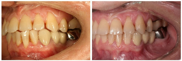 Aparat dentar ceramic