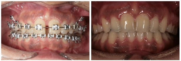 Caz finalizat prin utilizarea microimplant ortodontic
