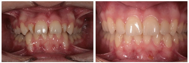 Malpozitie  dentara si sindrom clasa a doua
