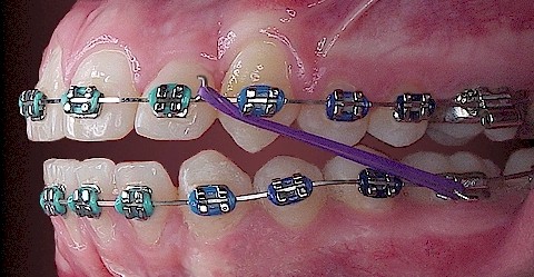 elastice_ortodontice