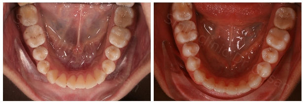 Aliniere dentara mandibula