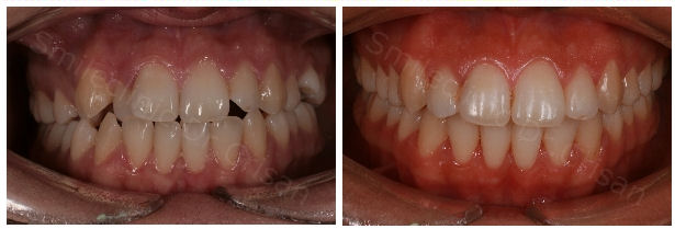 Inghesuiri dentare