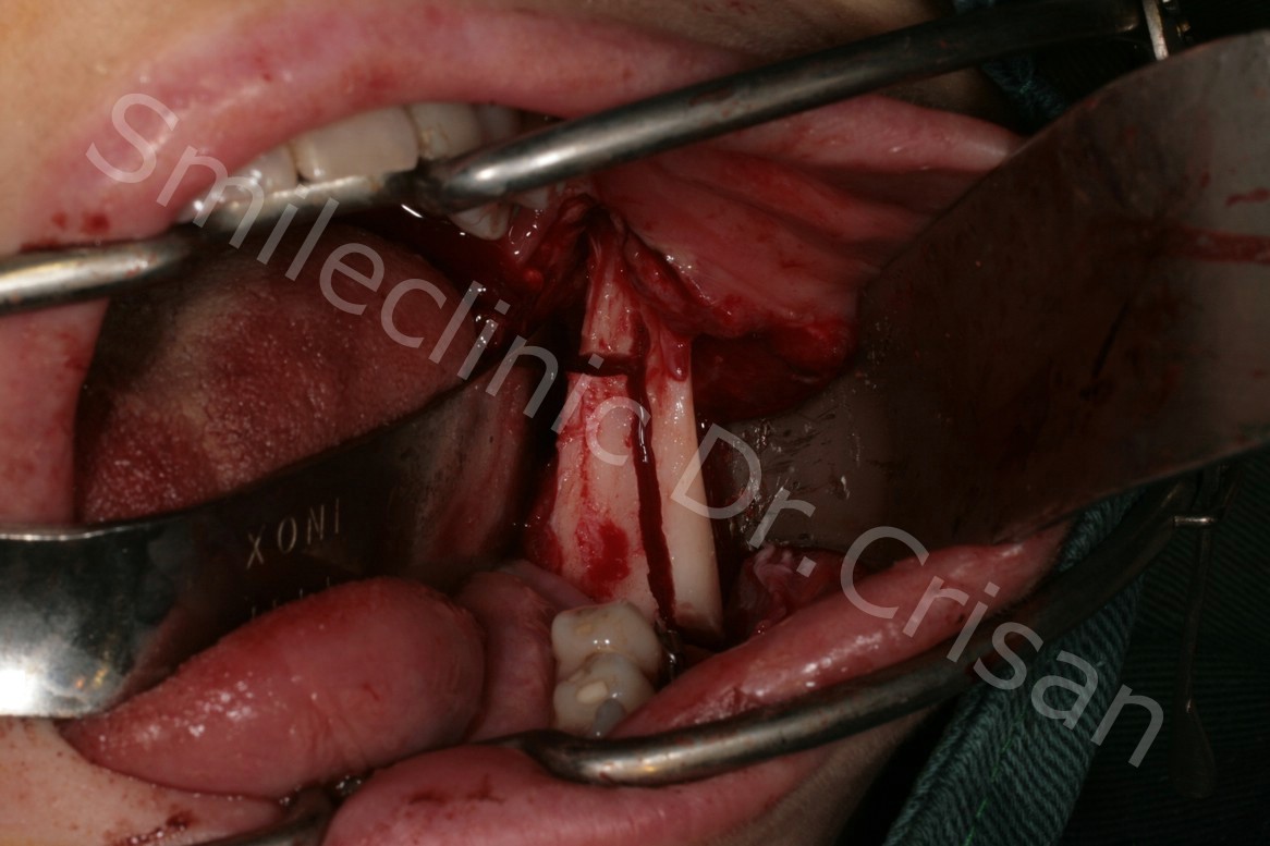 Interventie chirurgicala mandibula