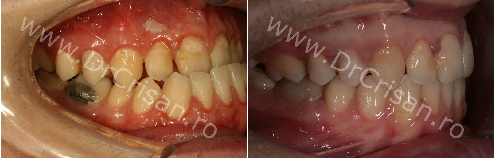 Fotografie ocluzie dreapta inainte si dupa tratamentul ortodontic