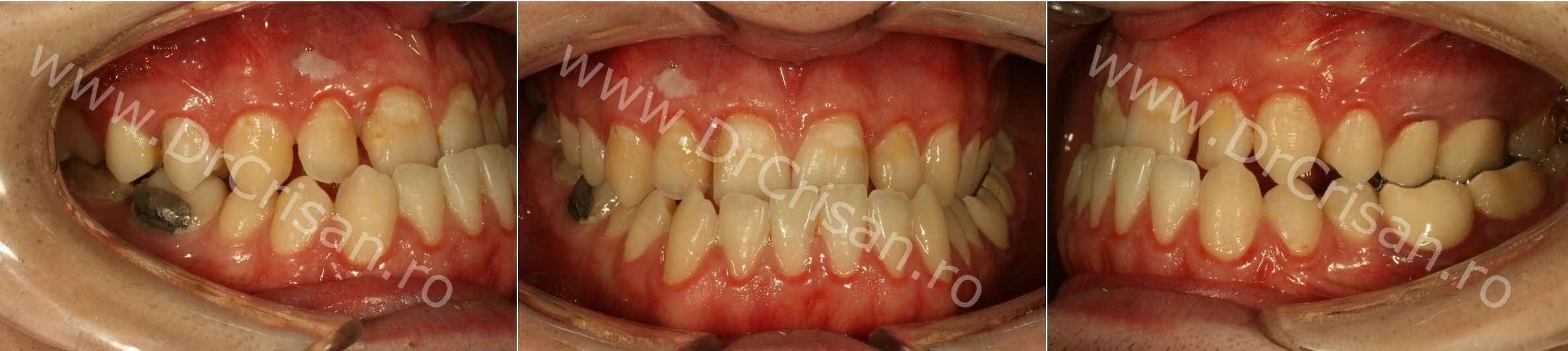 Interventie chirurgicala pacient cu aparat ortodontic Smileclinic DrCrisan