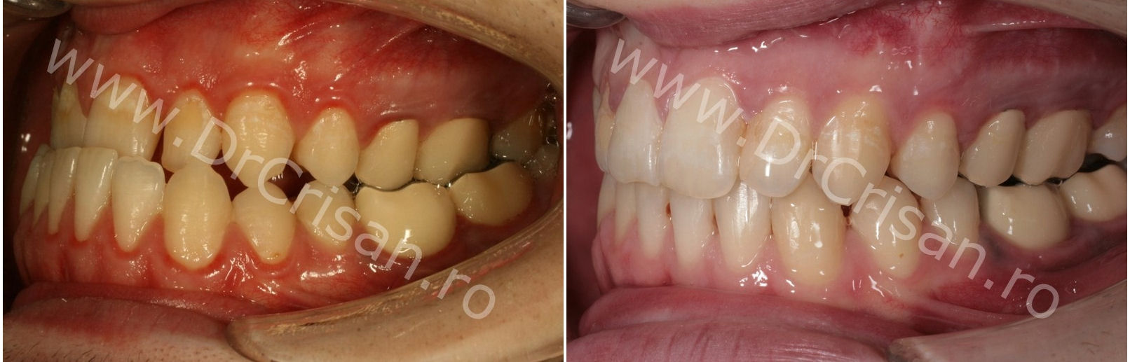Fotografie intraorala ocluzie cadran stnga dupa tratament cu aparat dentar si de chirurgie ortodnata