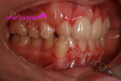 Tratament ortodontic adolescent