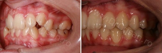 Malpozitie dentara