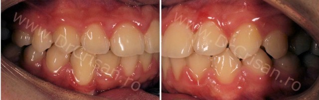 Fotografie intraorala dupa demontarea aparatului dentar