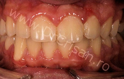 Canin redresat pe arcada - mandibula