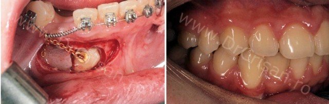 Canin 4.3 inclus la mandibula