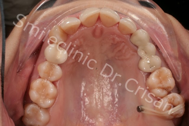 Time series The In Redresarea unui molar cu ajutorul unui aparat dentar | Dr Crisan - Afla  totul despre aparatele dentare fixe si Invisalign