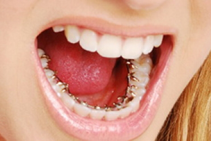 Choose ore plaster Aparat ortodontic fix lingual | Dr Crisan - Afla totul despre aparatele  dentare fixe si Invisalign